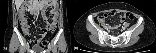Coronal (A) and axial (B) views of CT scan demonstrating tubular rim enhancing structure in the caecal lumen with surrounding fluid, suspicious for invaginated appendix, which was otherwise not identified.