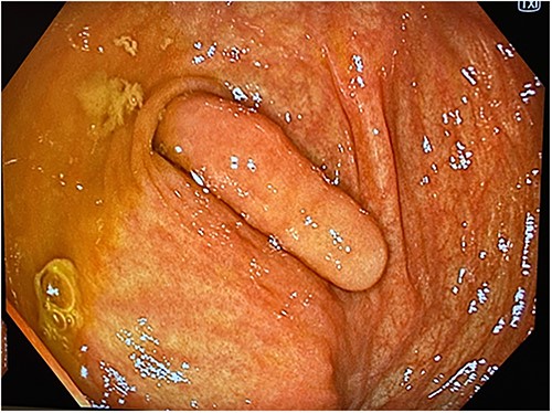 Colonoscopy image demonstrating a visible invaginated appendix within the caecal pole, with no other mucosal lesions or abnormalities seen.