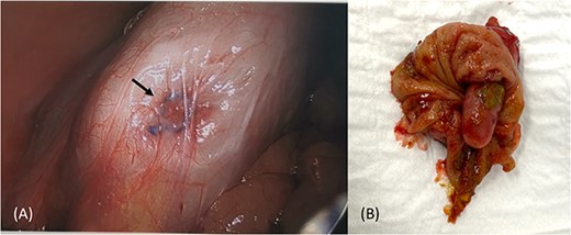 Intraoperative image of caecum with no visible appendix and suture material at the base (A), and partial caecetomy specimen showing an invaginated intact appendix (B).