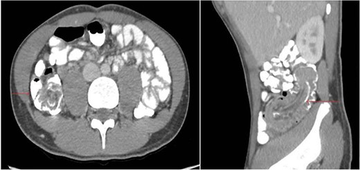 CT Abdomen (axial and sagittal plane) showing ileocolic intussusception extending for 10 cm with a soft tissue lesion at the tip of the intussusceptum concerning underlying lead point with reactive mesenteric lymph nodes.