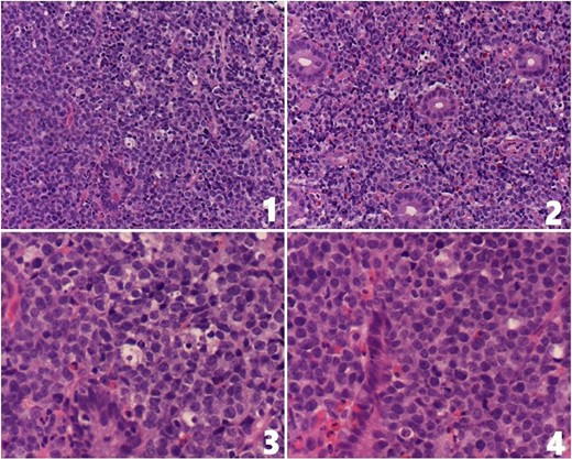 (1 and 2) Ileocecal mucosa showing infiltration by monotonous medium-sized lymphocytes displaying fine chromatin pattern and small nucleoli; tingible body macrophages are seen (H&E stain, 20×); (3 and 4) high-power magnification showing infiltration by monotonous medium-sized lymphocytes displaying fine chromatin pattern and small nucleoli. Apoptotic bodies and tingible body macrophages are present (H&E stain, 40×).
