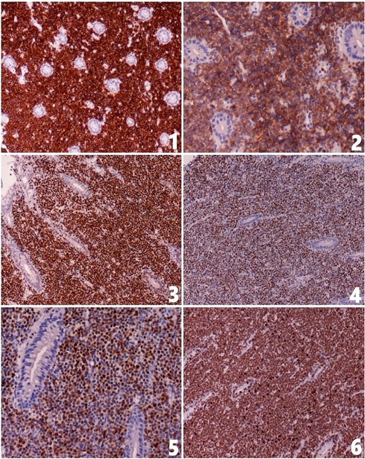 The tumor cells show positive staining for (1) CD79a, (2) CD10, (3) MYC, (4) BCL6 and (5) MUM1; (6) the Ki67 index is about 100%.