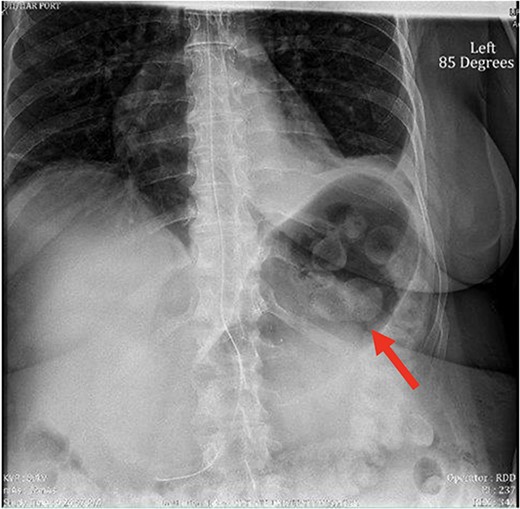 X-ray image of abdomen confirming persistent large gastric bubble despite adequately positioned NGT.