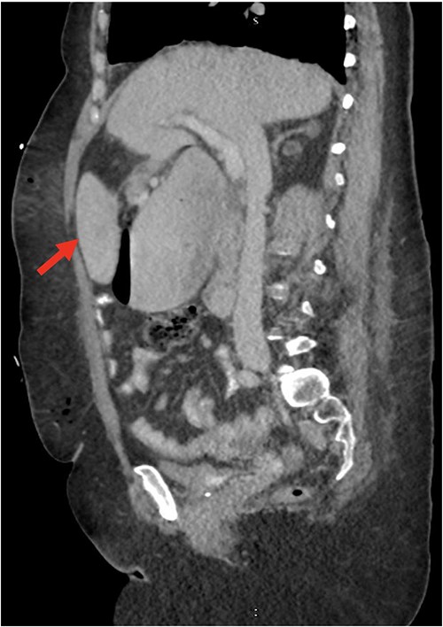 CT of the abdomen and pelvis (sagittal slice) showing gastric distention and the spleen positioned anteriorly.