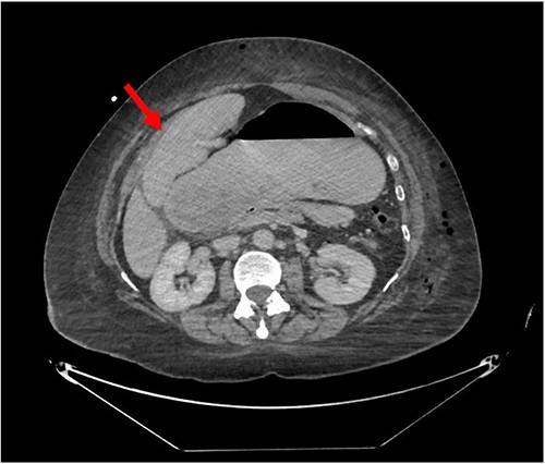 CT of the abdomen and pelvis (axial slice) showing gastric distention and the spleen positioned anteriorly in the right upper quadrant.