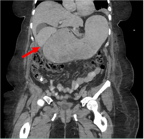 CT of the abdomen and pelvis (coronal slice) showing gastric distention and the spleen positioned in the right upper quadrant.