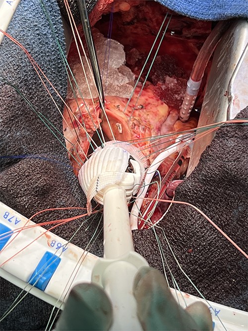 Custom-tailored graft.