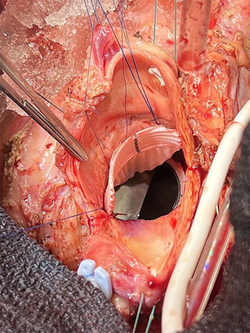 The composite graft implantation in aortic position with Dacron patch in situ.