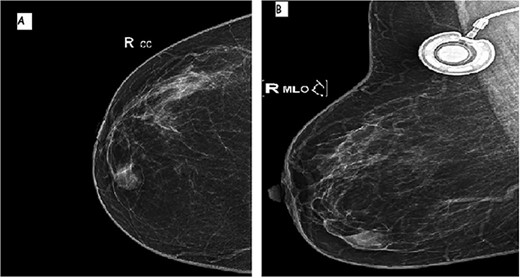 Mammographic image of the right breast, front (A) and side (B) views: inferior-internal quadrant mass of medium density, oval and circumscribed with partially indistinct margins without calcifications.