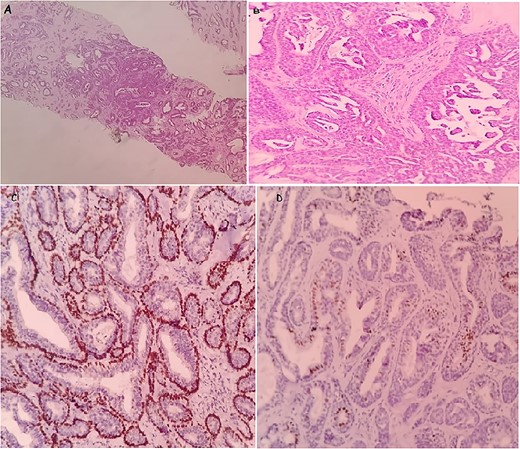 The microscopic images of the case in core needle biopsy: a well-limited tumor proliferation of glandular structures. Hematoxylin and eosin; ×10 (A). Double-cell population, regular epithelial cells and the second, external, corresponds to myoepithelial cells. Hematoxylin and eosin; ×40 (B). Immunohistochemical staining: showing the myoepithelial component was positive for p63 (C) and the epithelial component was positive for ER (D).