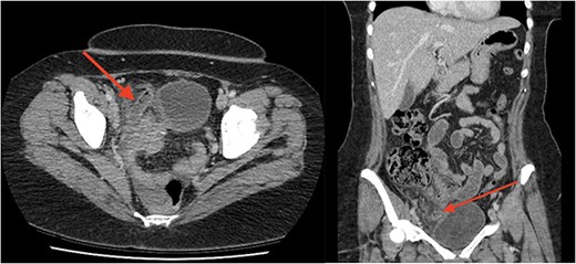 Axial (a) and coronal (b) images from portal-venous phase CT of the abdomen and pelvis demonstrating acute appendicitis. Arrow to inflamed, enlarged appendix.