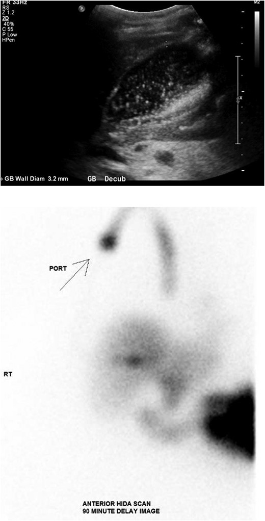 (Top) Ultrasound of the abdomen demonstrating distended gallbladder full of sludge with wall thickness of 3.2 mm. (Bottom) Nuclear medicine hepatobiliary scan demonstrating no gallbladder visualization after 90 minutes strongly supportive of acute cholecystitis.