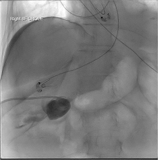PCT check using fluoroscopy showing retracted tube in the peritoneal fluid.