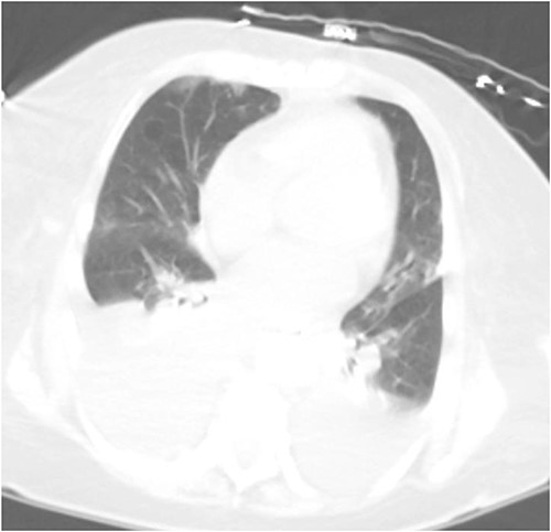 Computed tomography (CT) chest demonstrating bilateral pleural effusions.