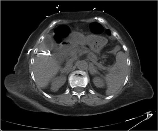 CT abdomen and pelvis demonstrating positioning of PCT.