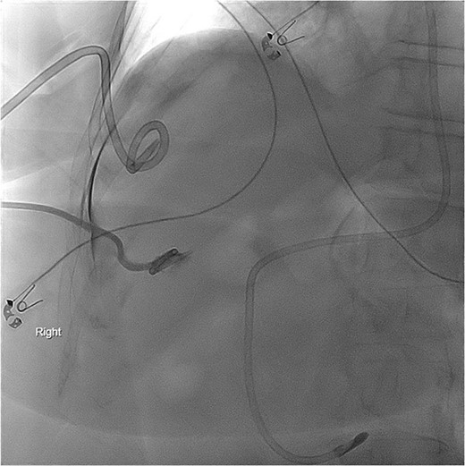PCT check using fluoroscopy showing the pigtail portion of the cholecystostomy tube within the gallbladder lumen as well as some leakage into the perihepatic space. No opacification of the pleural space.
