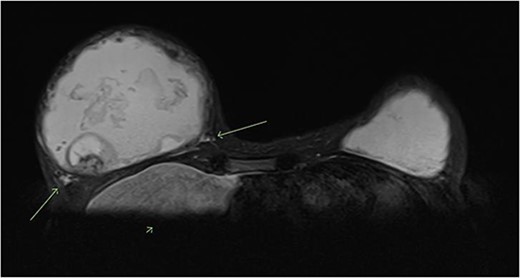 T2 weighted MRI of bilateral breasts—showing irregular borders of the fibrous capsule, heterogeneous material within the capsule, an intracapsular lesion, and extracapsular signal, suggestive of intracapsular and extracapsular breast implant rupture.
