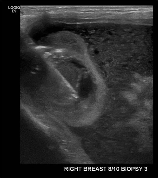 Ultrasound-guided core biopsy of the right intracapsular breast lesion.