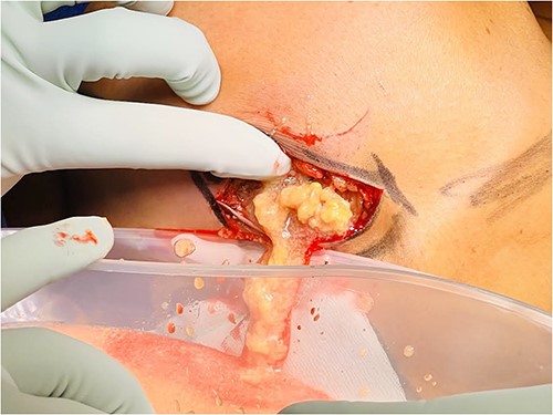 PAAG breast filler material being expressed out of an inframammary fold incision of the right breast.