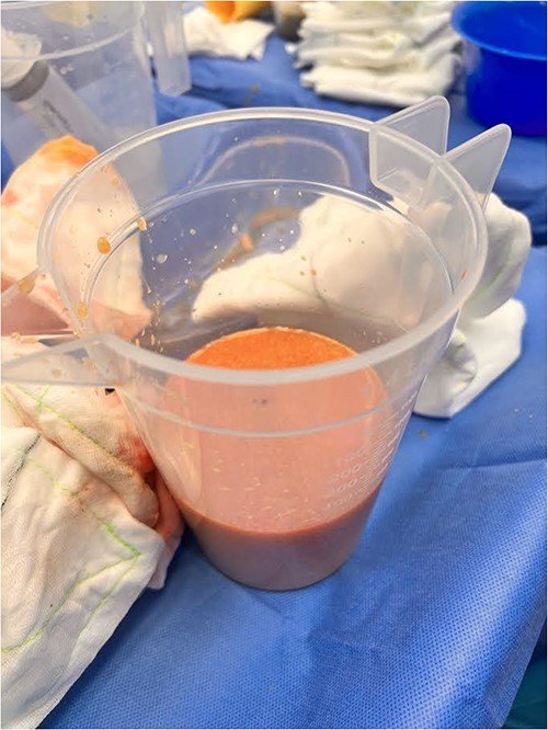 Evacuated PAAG breast filler from patient’s right breast.