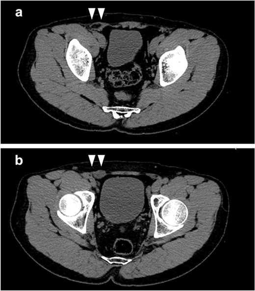(a) Intra-abdominal fat was found to be prolapsed from the lateral side of the inferior epigastric vessels; (b) a low-density mass (white arrows) in the cranial side of the internal inguinal ring was detected, which was considered to be an intraperitoneal testis.