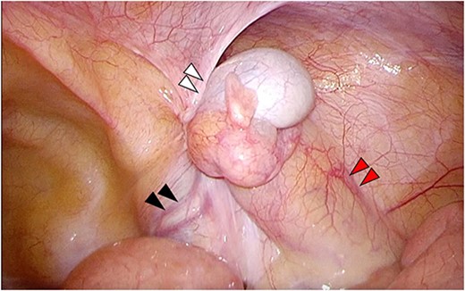 Laparoscopy reveals a white mass (white arrows) dorsal part of the hernia orifice; the deferent duct (black arrows) and testicular vessels (red arrows) were observed.