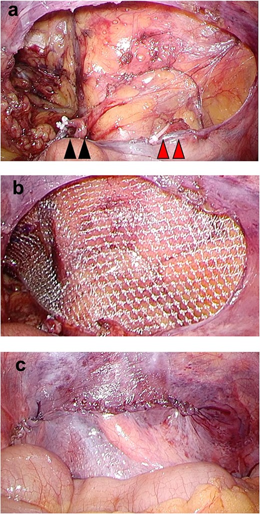 (a) The deferent duct (black arrows) and testicular vessels (red arrows) were divided after clipping; (b) a mesh was inserted leaving the ductus deferens and arteriovenous vein of the testis on the peritoneal side; (c) suture closure was done and the testis was removed and hernia repair was completed.