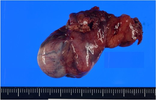 The resected right testis was a atrophic testis grossly and was 30 mm in size.