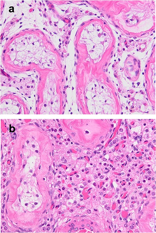 (a, b) HE staining; extensive hyalinization of seminiferous tubules and accumulation of Leydig cells associated with undescended testis were observed; almost no semen formation was observed in the seminiferous tubules; there were no malignant findings.