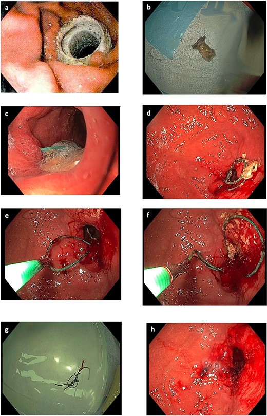 Endoscopic images. (a) AXIOS stent™ in situ. (b) AXIOS stent removed. (c) Sutures eroded, viewed endoscopically. (d) Eroded sutures viewed endoscopically within gastric body. (e) Endoscopic removal of sutures. (f) Endoscopic removal of sutures. (g) Sutures removed. (h) Gastric body following removal of sutures.