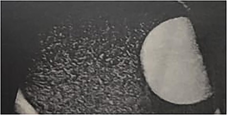Ultrasound of the hydrocele.