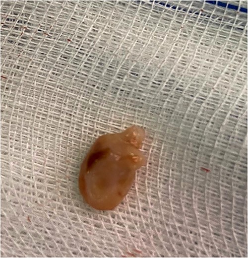 Photograph of hydrocele stone.