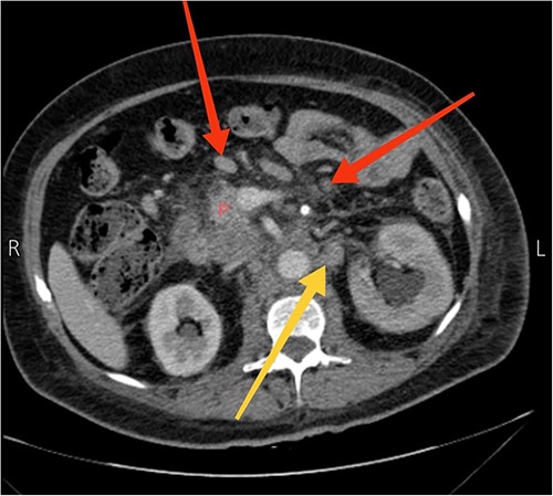Axial view CT scan showing the head of the pancreas (P), enlarged peripancreatic lymph nodes (the two arrows at the top), and a 4.1 × 2.4 cm necrotic and heterogeneous enlarged lymph node in the para-aortic area (the arrow at the bottom).