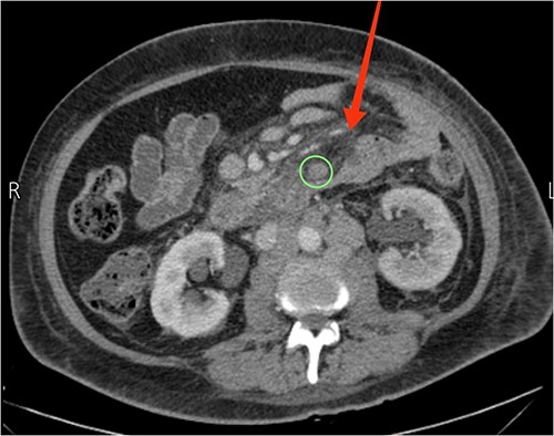 Axial view CT showing prominent mesenteric edema with jejunal wall thickening and surrounding fat stranding (arrow). An enlarged mesenteric lymph node can also be seen (circle).