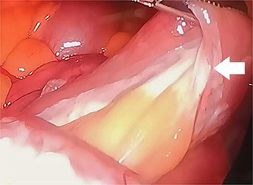 Laparoscopic findings demonstrate a milky or whitish jejunal mesentery (arrow).