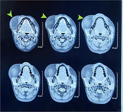 Preoperative MRI showing right cheek mass.