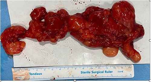 Surgical specimens measuring 20 cm.