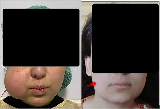 (A) Preoperative right cheek lipoma. (B) Postoperative after 6 months follow up.
