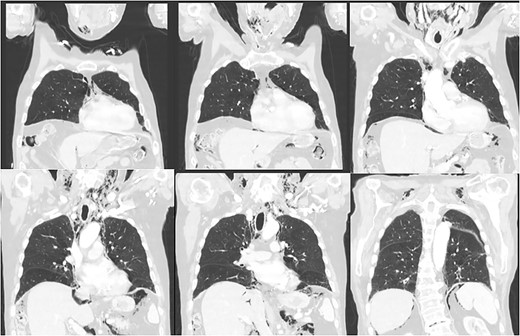 CT scan of the chest demonstrating subcutaneous emphysema and extensive free gas in the mediastinum and retroperitoneum.