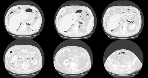 CT scan of the abdomen and pelvis demonstrating perforation of the sigmoid colon and free gas in the retroperitoneum and mediastinum.