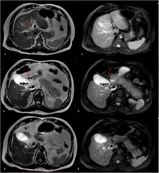 Magnetic resonance cholangiopancreatography (MRCP) axial imagen. A: T2W- TSE; B, T2W- SPIR. A and B findings right posterior hepatic duct absence of signal, choledochal with presence of heterogeneous content with absence of signal in intrapancreatic portion (arrows).
