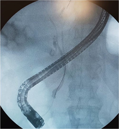Cholangiography by ERCP revealed insertion of the CD RHD.