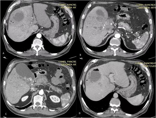 Axial TC on shows liver of regular contours, heterogeneous at the expense of multiple collections that follow the course of the bile duct of diffuse distribution. A and B on different sections: abscess on segments V and VIII, measures 58 × 56 × 67 mm in its major axes and has an approximate volume of 100 cc, presents air-fluid level. The bile duct measures 3.5 mm. C: Distended thin-walled gallbladder with stones inside with an axis >100 mm and calculous cholecystitis. D: (Venous phase). The portal vein is observed with hypodense material inside with partial defect in filling of the contrast agent at the level of the hilum with complete extension toward the right branch.
