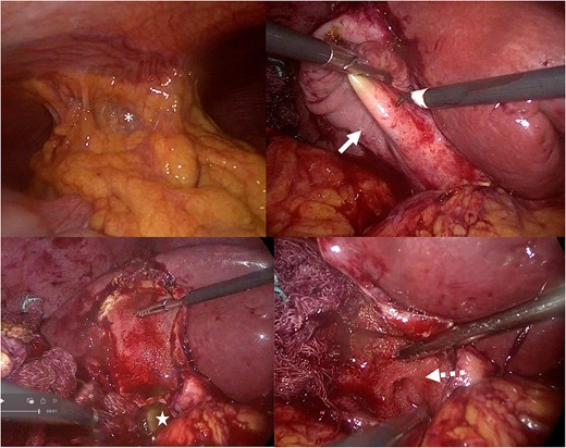 Intraoperative picture: subtotal cholecystectomy fenestrating laparoscopic. A: Inability to visualize the gallbladder due to adhesions (white asterisk): Parkland V. B: Gallbladder (solid arrow) with thickening of the wall. C: Visualization the calculus star). D: The cystic (dotted arrow) was found transversal.