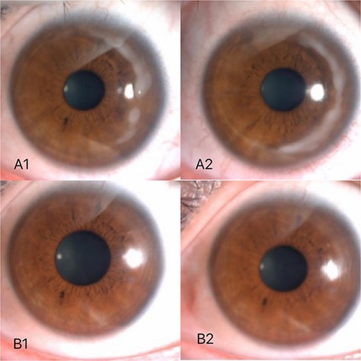 Three days after surgery, white stromal infiltration around the flap margin from 12 o’clock to 6 o’clock (A2) with intact but less regular epithelium. Examination of the left eye revealed the same lesion from 12 o’clock to 3 o’clock (A1). About 3 months after surgery,only a small amount of cloudy corneal opacity remained in both eyes (B1, B2).