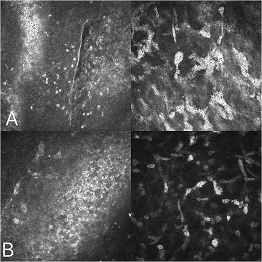 Corneal confocal microscopy on the third postoperative day: inflammatory cell infiltration was observed in the corneal epithelial layer (A), and a pine needle-like hyperreflective was observed in the superficial corneal stromal layer (B).