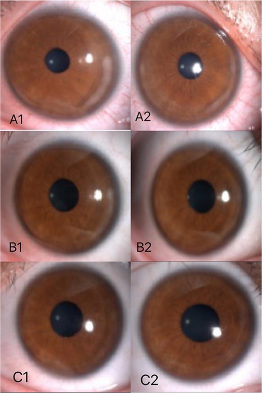 The third day after surgery, in the left eye, white infiltration was seen at the edge of the flap and the surrounding stromal within a range of 1 mm from 3 o ‘clock to 5 o ‘clock (A1). In the right eye, white infiltration was seen at the edge of the flap and the surrounding stromal from 1 o’clock to 5 o’clock and from 7 o’clock to 9 o’clock (A2). On the sixth day after surgery, lesions still existed in both eyes without further development and expansion (B1, B2). According to the last review,the infiltrations in both eyes almost disappeared (C1,C2).