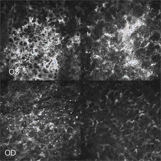 Corneal confocal microscopy: Inflammatory material deposition in the stromal layer was significantly reduced.