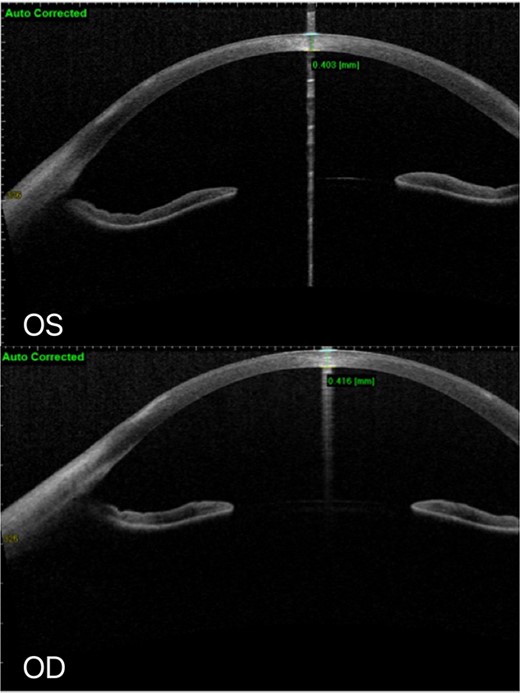 At the latest review, AS-OCT: No defect of corneal epithelium in both eyes, and white infiltration of superficial corneal stroma remained.