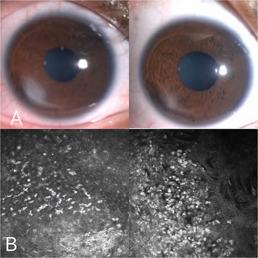 One month later after the surgery, white confluent stromal infiltrate peripheral to the flap edge, from 6 to 8 o’clock in the right eye accompanied by local epithelial defects (A); One week later after the Steroid treatment, reexamination showed that the infiltration of the right eye was alleviated (A). Corneal confocal microscopy:inflammatory cells and inflammatory exudates in the epithelial and interstitial layers but no evidence of infection (B).